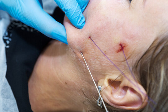 Close-up anti-age facial lifting procedure using PDO threads of polylactic acid applied in the face with aseptic cannula before extending skin