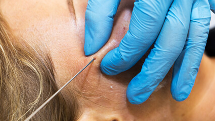 Close-up anti-age facial lifting procedure using PDO threads of polylactic acid applied in the face with aseptic cannula before extending skin