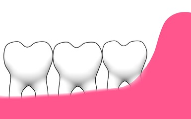 Gingival recession in lower molar posterior teeth