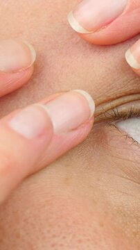 Close-up of the eye area. Eyelid. Oily skin, milia, and papule around the eyes. The concept of treating problematic facial skin, laser removal of milia.