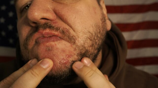 Adult man and skin problems. Acne.