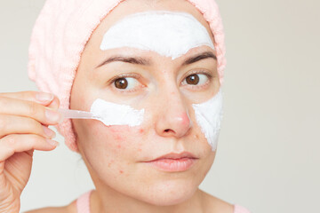 A young Caucasian woman with a pink headband suffering from chronic rosacea disease in the acute stage applying a therapeutic ointment to the skin of the face