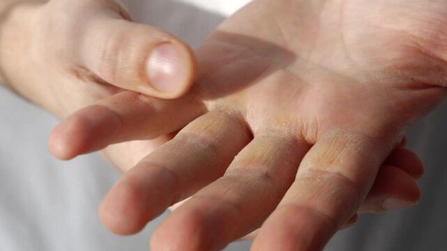 Atopic skin.
Sensitive skin to frost.
Dry and chapped hands after frost.
Allergy to palms in humans.
Allergic reaction to severe frost.
Damaged skin on hands