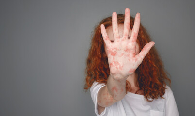 Stop Measles. Woman With Red Spots On Palm Over Grey Background, Copy Space