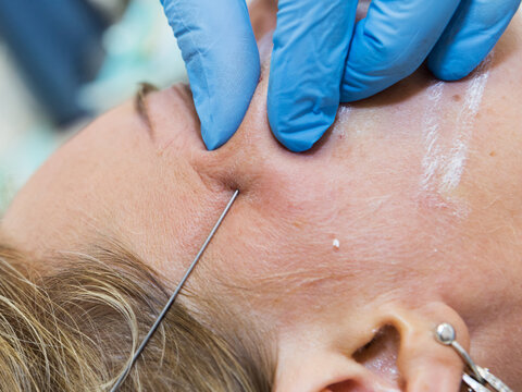 Close-up anti-age facial lifting procedure using PDO threads of polylactic acid applied in the face with aseptic cannula before extending skin