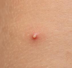 Fototapeta premium A small red bump on a person's arm
