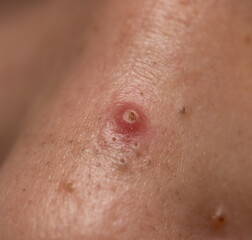 Fototapeta premium A red bump on a person's arm