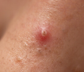 Fototapeta premium A red bump on a person's arm