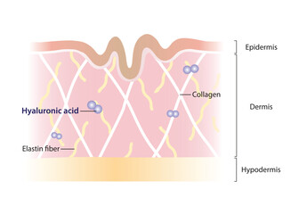 Diagram of Hyaluronic acid decrease in dermis layer vector illustration on white background. Cross section of aging skin with small amounts of shorter hyaluronic acid. Skin care and beauty concept.