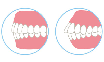 キレイな歯並びと、歯が出た歯並び　口ゴボ　歯列矯正 © koti