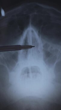 Doctor learning Vertical X-ray scan of a human skull. Deviated septum. Nasal septum, bone and cartilage that divide the nose in the middle is crooked.