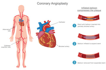 Coronary angioplasty is a minimally invasive procedure to open blocked heart arteries using a balloon and stent, improving blood flow and reducing heart attack risk