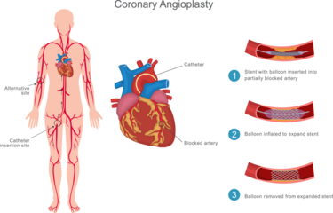 Coronary angioplasty is a minimally invasive procedure to open blocked heart arteries using a balloon and stent, improving blood flow and reducing heart attack risk