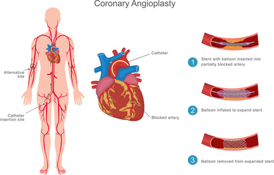 Coronary angioplasty is a minimally invasive procedure to open blocked heart arteries using a balloon and stent, improving blood flow and reducing heart attack risk