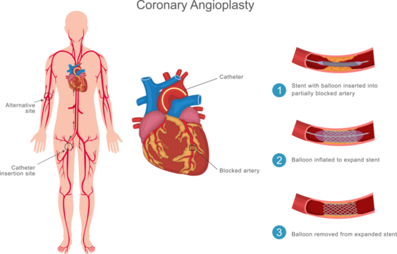 Coronary angioplasty is a minimally invasive procedure to open blocked heart arteries using a balloon and stent, improving blood flow and reducing heart attack risk