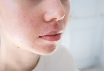 Close up of young woman with acne and post-acne marks on her cheeks. Hormonal acne, puberty and...