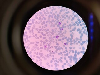 Plasmodium vivax is a protozoal parasite and a human pathogen. This parasite is the most frequent...