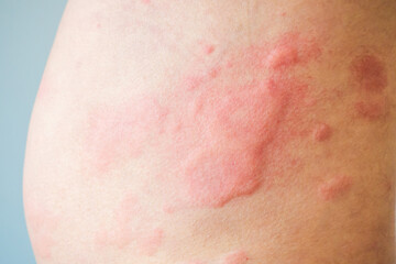 Skin allergy rash dermatitis texture close up background