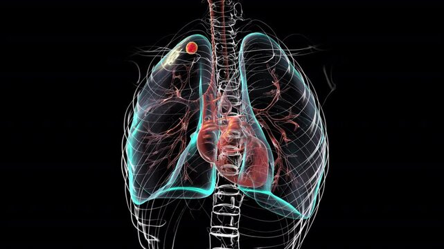 Lungs affected by apical tuberculosis, animation