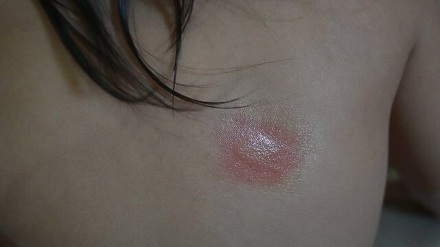 Mosquito bite marks on the skin of a toodler child's back.	