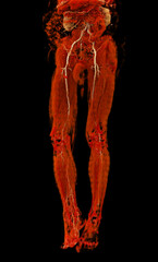 3D CTA of Lower Extremities:.A clear 3D visualization of the femoral artery and lower body skeleton, supporting vascular and orthopedic assessment.