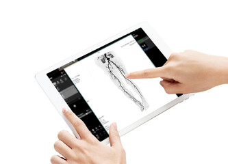A detailed CTA scan of the femoral arteries is displayed on a digital tablet, with hands pointing to vascular structures, isolation on white background, clipping path.