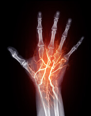 X-Ray and Vascular Imaging of Hand:.This image combines X-ray bone structure with glowing red vascular pathways, showcasing detailed blood flow and skeletal anatomy.
