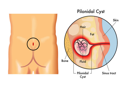 Medical illustration of pilonidal cyst, with annotations.