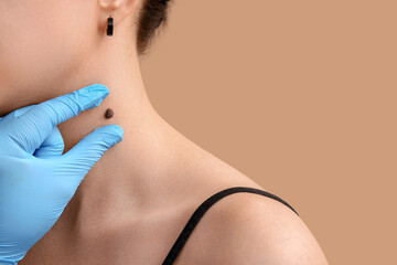 Dermatologist examining moles of patient on beige background