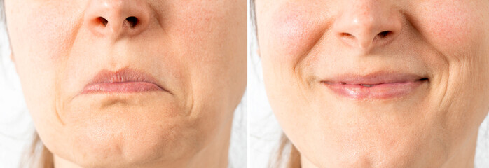 Mouth with pursed lips expressing negativity, disapproval, mimic wrinkles. The same face with...