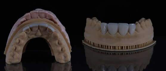 Dental aesthetics in dentistry with digital smile design treatment. Computer assisted jaw and mouth model with glass-ceramic porcelain laminate veneers. E-Max leaf porcelain dental crowns.  © UniqDream