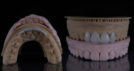 Dental aesthetics in dentistry with digital smile design treatment. Computer assisted jaw and mouth model with glass-ceramic porcelain laminate veneers. E-Max leaf porcelain dental crowns.  © UniqDream