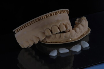 Aesthetic smile design treatment in dental dentistry. Dental laminate veneers and computer-assisted jaw and mouth model mockup with porcelain laminates.  © UniqDream