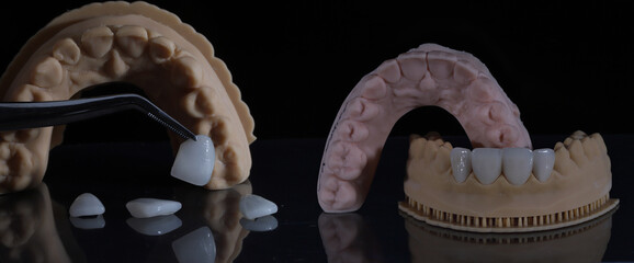 Aesthetic smile design treatment in dental dentistry. Dental laminate veneers and computer-assisted jaw and mouth model mockup with porcelain laminates.  © UniqDream