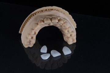 Dental laminate veneers with a jaw model prepared using digital smile design in aesthetic dentistry. Porcelain, zirconia, and E-Max dental crowns. smile makeover.  © UniqDream