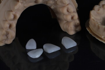 Dental laminate veneers with a jaw model prepared using digital smile design in aesthetic dentistry. Porcelain, zirconia, and E-Max dental crowns. smile makeover.  © UniqDream