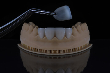 Dental laminate veneers with a jaw model prepared using digital smile design in aesthetic dentistry. Porcelain, zirconia, and E-Max dental crowns. smile makeover.  © UniqDream