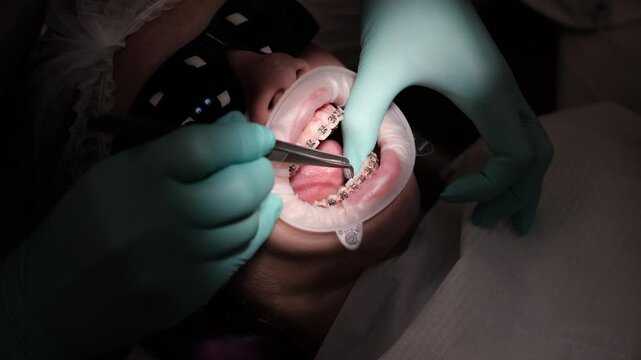 The end of wearing braces. The stage of gluing retainers on teeth
