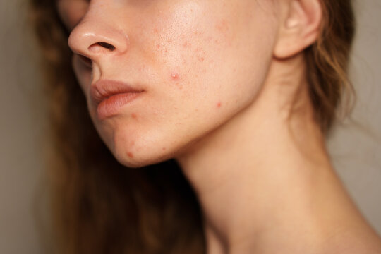 real acne close-up of a woman's face, dark spots, no make up, no retouch, natural skin, problematic
