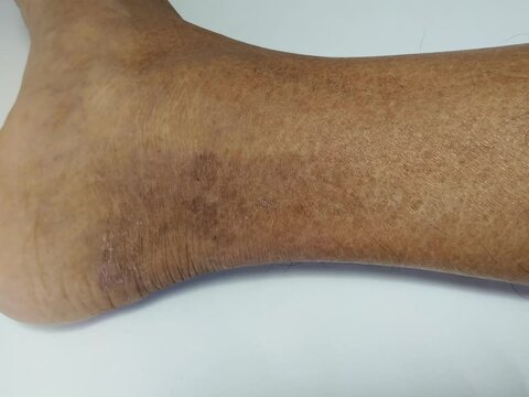 A close-up view of the skin on the feet of diabetics shows cracks accompanied by discoloration which may be edema, which indicates potential complications of diabetes.
