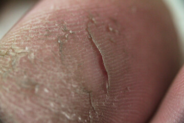 Fototapeta premium Close up of cracked dry skin on toe foot, dermal health and disease