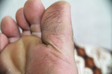 Close up of cracked dry skin on toe foot, dermal health and disease