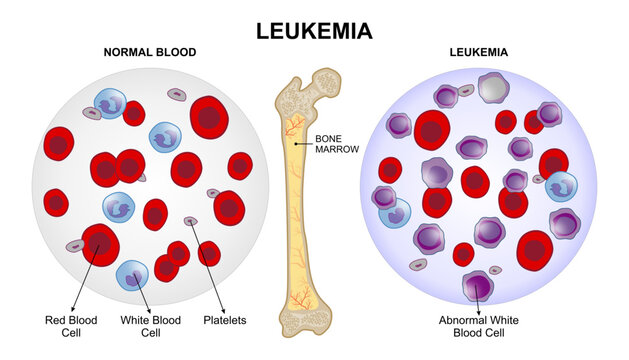 Leukemia Blood Cancer Illustration