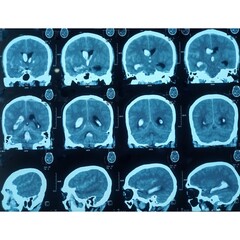 CT scan of brain, Intraventricular hemangioma with adjoining periventricular seepages and...