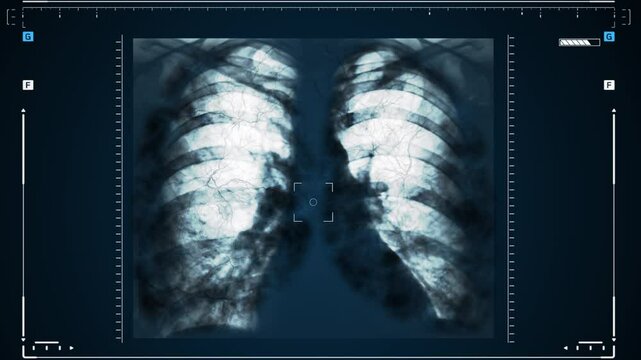 X-rays of the human lungs or physical therapy for doctors with lung problems Such as viruses entering the lungs. Complications after pneumonia, covid - 19, tuberculosis or smoking.