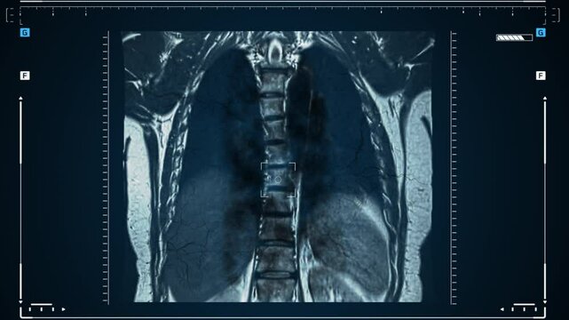 X-rays of the human lungs or physical therapy for doctors with lung problems Such as viruses entering the lungs. Complications after pneumonia, covid - 19, tuberculosis or smoking.