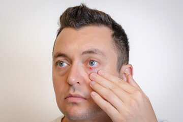 Obraz premium Man's eyes with pus redness like chalazion caused by blocked sebaceous glad on lower eyelid. Hordeolum. Viral infection