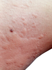 Fototapeta premium The Huge Urticaria allergy symptoms on Skin