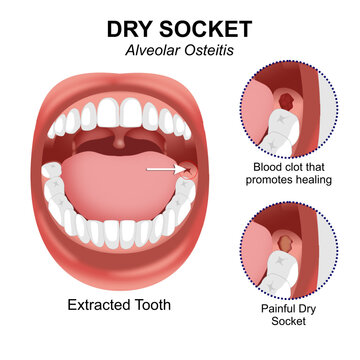 Alveolar Osteitis Dry Socket