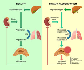 Aldosteronoma Healthy and primary aldosteronoma
